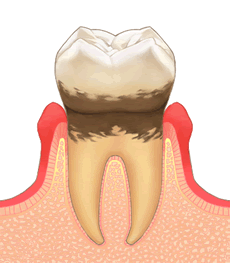 軽度歯周病