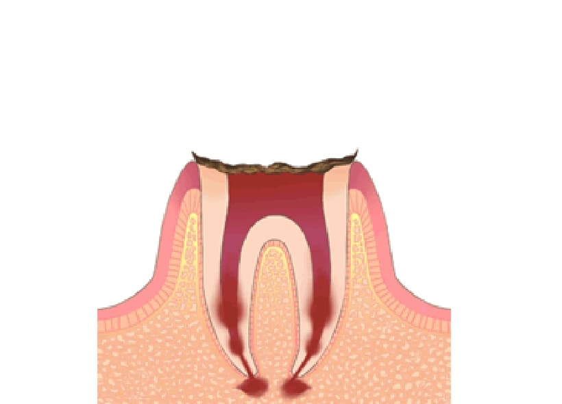 むし歯治療のご相談はひたちなか市の歯医者｜浅香歯科